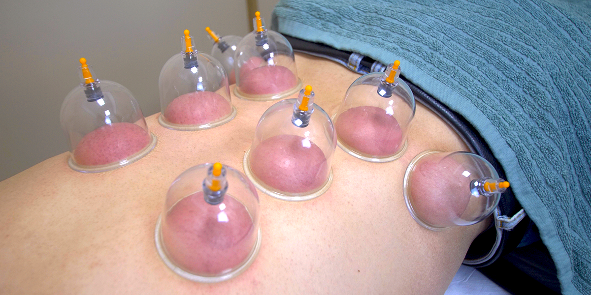 cupping for back pain