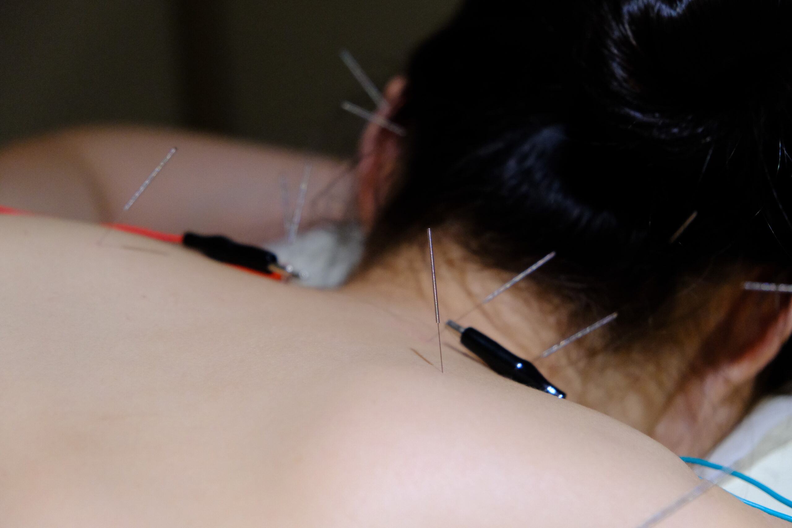 acupuncture singapore - acupuncture service at regis medical gp clinic .JPG